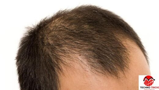 Androgenetic Alopecia